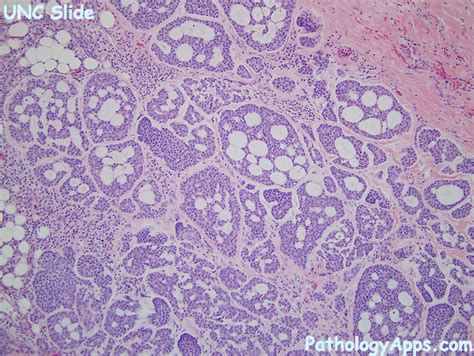 adenoid cystic carcinoma pathology