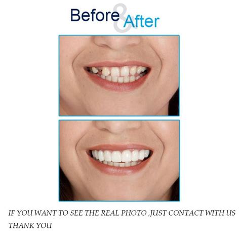 Snap On Smile - Instant Smile Veneer | Snap on smile, Cosmetic veneers ...