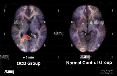 PET Scan, Normal and OCD Brain Stock Photo - Alamy