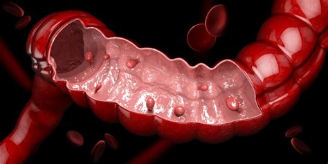 Your guide to making polyp removal decisions - American Gastroenterological Association