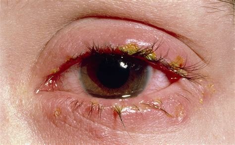 Eye Diseases: 10 Common Eye Diseases