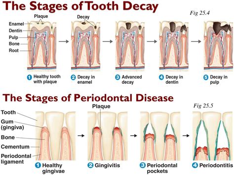 Stages Of Tooth Decay