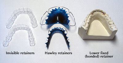 Types of Retainers — Good Day Orthodontics | Santa Maria, CA