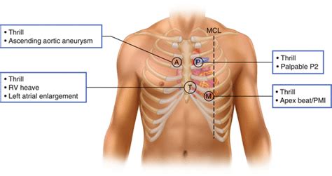 Introduction to Cardiac Auscultation | Thoracic Key