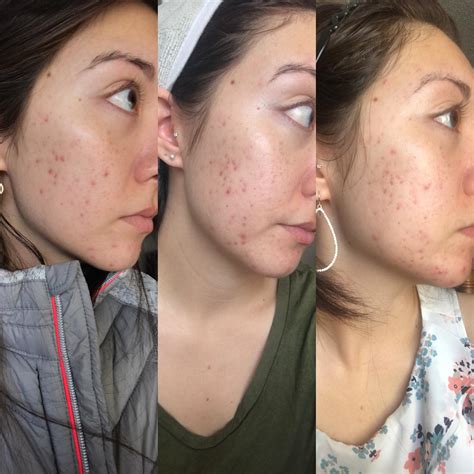 [Skin Concerns] 2 Months on Differin.. should the purge be like this? : r/SkincareAddiction