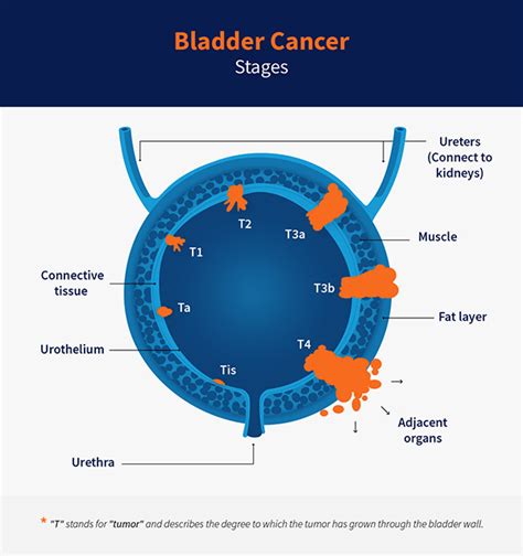 Bladder Cancer Stages | Cxbladder