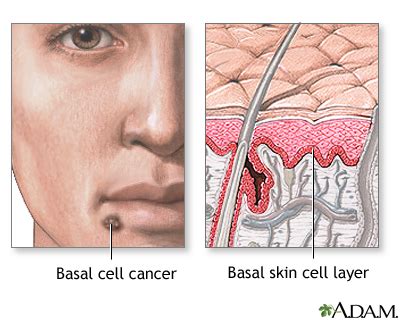 Basal cell cancer: MedlinePlus Medical Encyclopedia Image