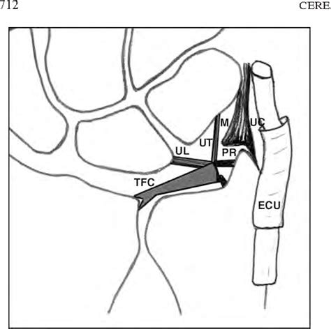 Ulnar Collateral Ligament Wrist Mri