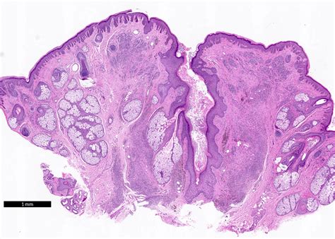 Nevus Comedonicus Histology