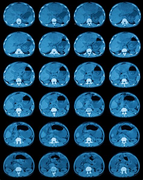 What is a Spleen CT scan? | Two Views