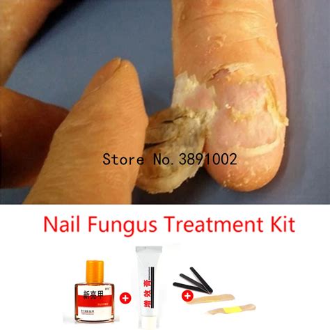 Herbal Fungal Nail Treatment Essence Toe Nail Finger Anti Fungus ...