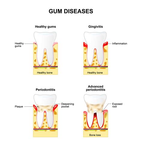 Gum Disease Diagram