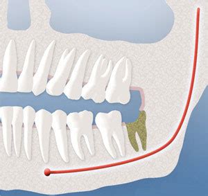 After Extraction of Wisdom Teeth Lawrence KS | Dry Socket, Infection