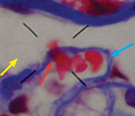 Dysmorphic red blood cell formation | Cleveland Clinic Journal of Medicine