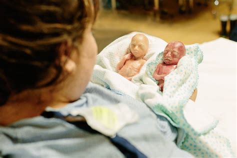 Born premature at 22 weeks, identical twins are sharing the truth about abortion - Live Action News