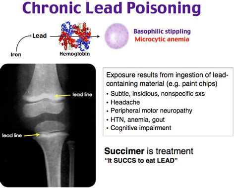 Chronic Lead Poisoning : Mnemonic | Epomedicine