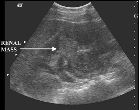 Kidney Tumor Ultrasound