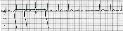 ECG Channel: Sinoatrial Block or Sinoatrial Exit Block