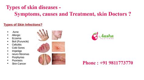 Types of skin diseases - Symptoms, causes and Treatment, skin Doctors