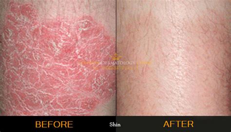 Psoriasis Treatment (£195) | London Dermatology Clinic