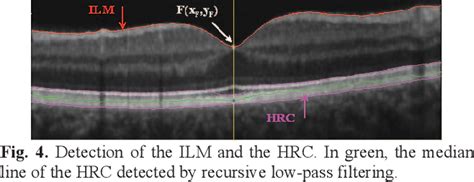 Figure 4 from Automated segmentation of retinal layers in OCT imaging and derived ophthalmic ...