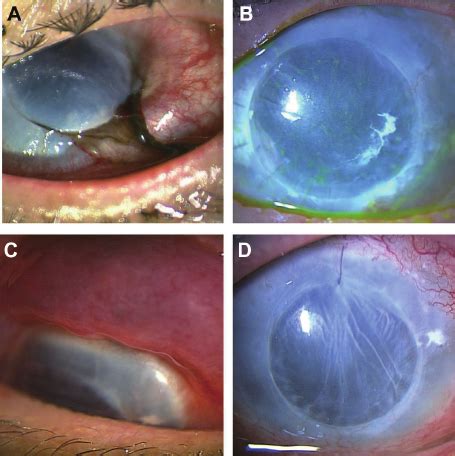 A 67-year-old man experienced repeated globe ruptures; the first rupture | Download Scientific ...