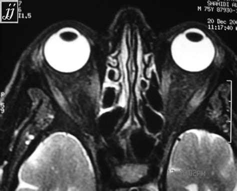 Optic nerve sheet tumor – Radiopaedia