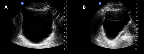 Bladder Point-of-Care Ultrasound - OpenAnesthesia