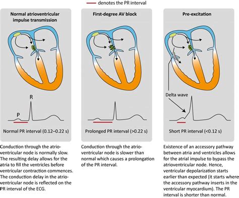 The PR Interval & PR segment – Cardiovascular Education