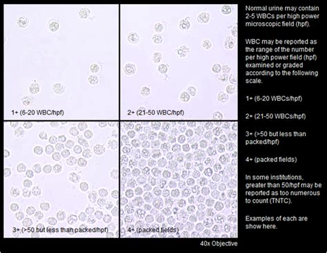 urine with white sediment