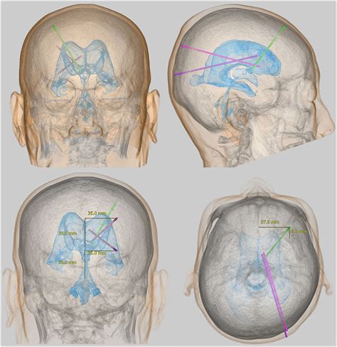 Ventriculoperitoneal Shunt Complications