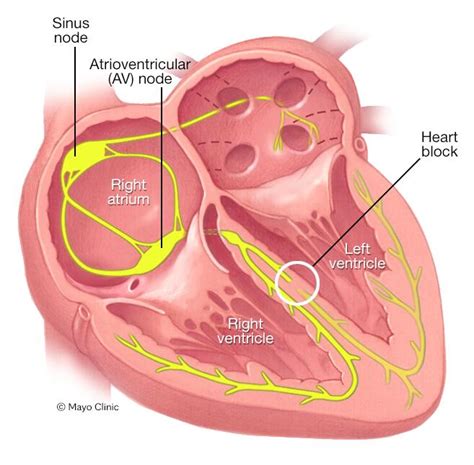 Bundle branch block - Symptoms & causes - Mayo Clinic