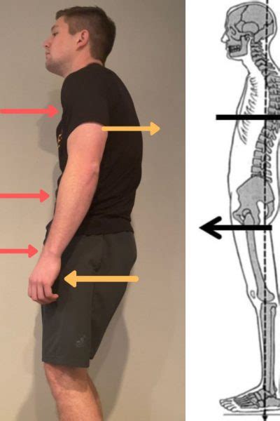 Swayback Posture with Anterior Compression - Progress Posture