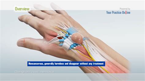 Ganglion Cyst Drainage Cpt - Best Drain Photos Primagem.Org