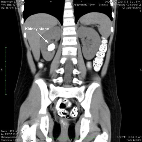 pediatric-kidney-stone-CT