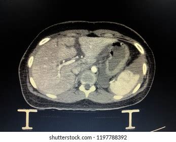 Liver Laceration Hemoperitonium Ct Scan Whole Stock Photo 1197788392 | Shutterstock