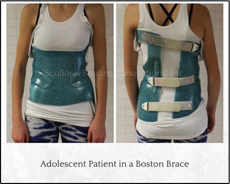 Comparing Scoliosis Braces - Scoliosis Bracing Innovations