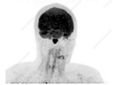 B-cell lymphoma, PET scan - Stock Video Clip - K008/6050 - Science Photo Library