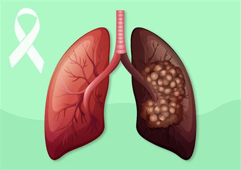 Lung Cancer Awareness – Symptoms, Stages and Treatment - mHospital