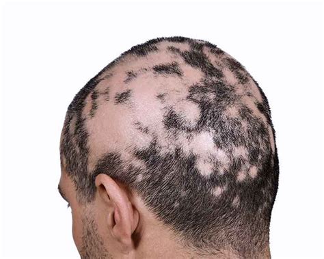 Alopecia Areata - Avens Blog | Avens Blog