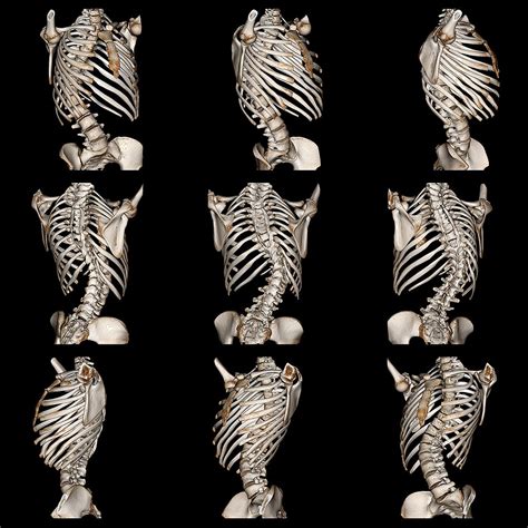 Types of Scoliosis Braces