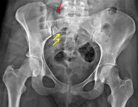 Closed fracture of sacrum - boothtery