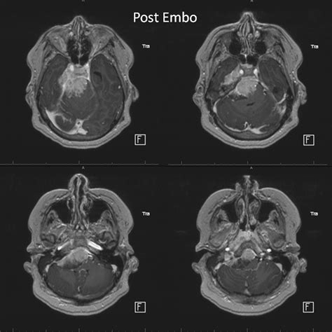 Case Archives Petroclival Meningioma MHT and ILT access | neuroangio.org