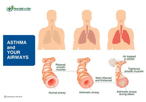 Asthma | Stay Safe for Older People