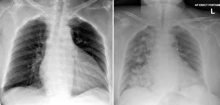 Aspiration pneumonia - Radiology at St. Vincent's University Hospital