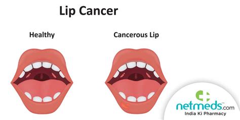 Lip Cancer: Causes, Symptoms And Treatment