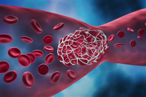 Anticoagulant drugs: list and side effects | Emergency Live