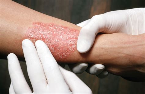 Psoriasis Treatment With Biologics Often Requires Multiple Courses ...