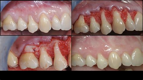 The Beauty in periodontal plastic surgery | Periocampus Herald