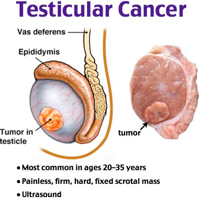 Testicular Cancer Pictures Photos